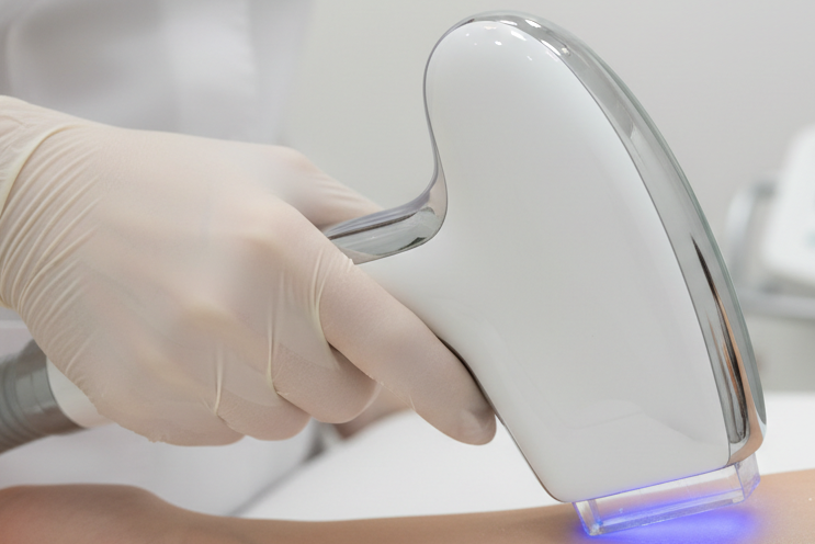 IPL laser treatment